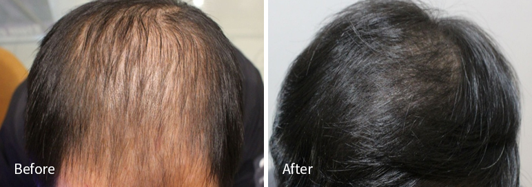 /filedata/md_board/20260102170916_9V2xrQN5_afterEBAAA8EBB09CEC9DB4EC8B9D_2.jpg 전후사진