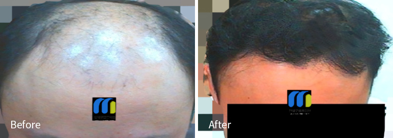 /filedata/md_board/20260102171634_c3mSVY64_afterEBAAA8EBB09CEC9DB4EC8B9D_17.jpg 전후사진