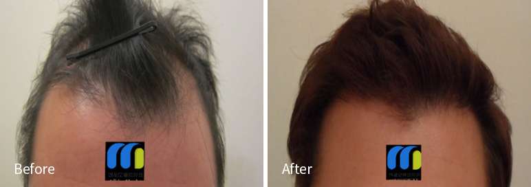 /filedata/md_board/20260102171739_8dxCw7z5_afterEBAAA8EBB09CEC9DB4EC8B9D_20.jpg 전후사진