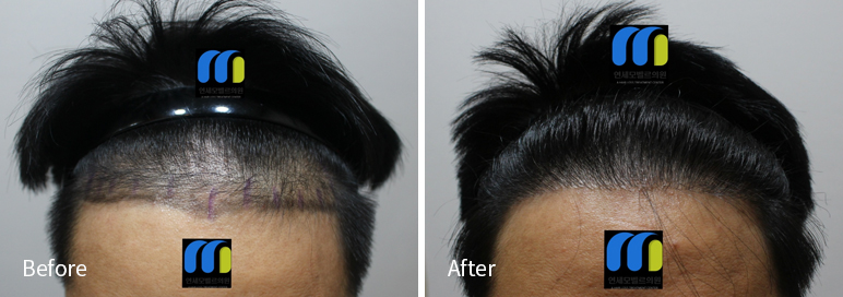 /filedata/md_board/20260102171840_LYaBDocm_afterEBAAA8EBB09CEC9DB4EC8B9D_24.jpg 전후사진