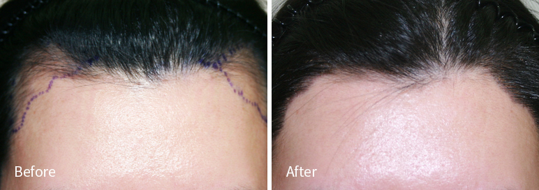 /filedata/md_board/20260102182834_keWDafwh_afterED97A4EC96B4EB9DBCEC9DB8_1.jpg 전후사진