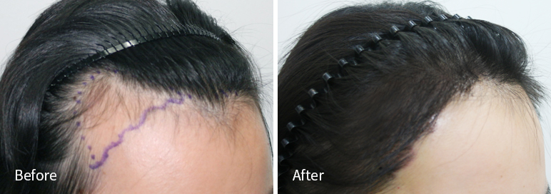 /filedata/md_board/20260102183046_iYuO2gpf_afterED97A4EC96B4EB9DBCEC9DB8_9.jpg 전후사진