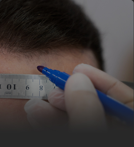 연세모벨르의원 SMP 두피문신